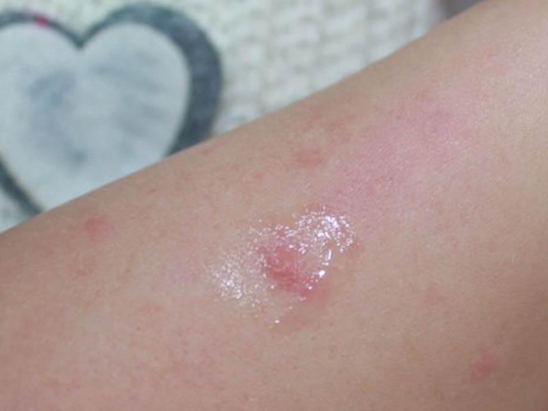 How and what to treat bed bug bites on the human body