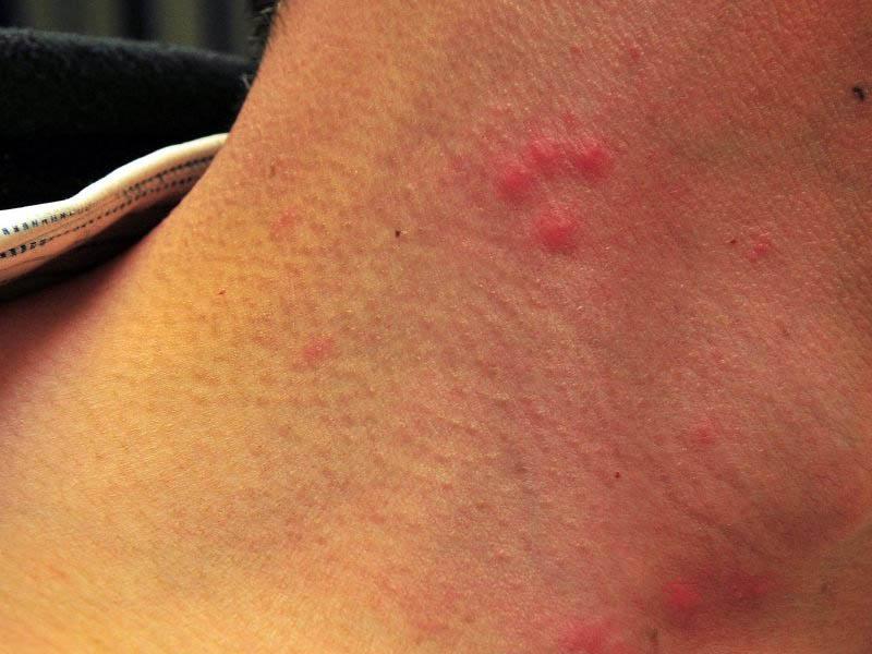 The 15 most effective ointments for bed bug bites: how and what to treat (to ointment) a person from bed bugs