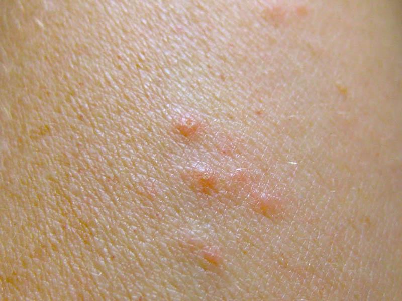 Bed bug bites: what they look like (close-up photos), symptoms, signs, first aid