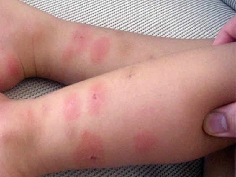Piqûres de punaises de lit chez l'enfant : à quoi elles ressemblent, comment les frotter et les traiter, quels sont les dangers ?