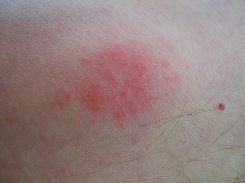 Réaction allergique aux piqûres de punaises de lit