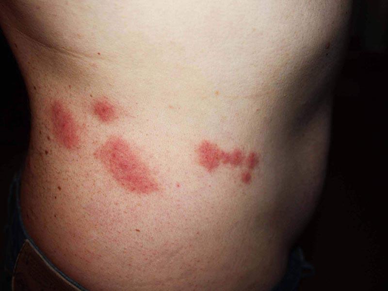 Reazione allergica alle punture di insetti dei mobili