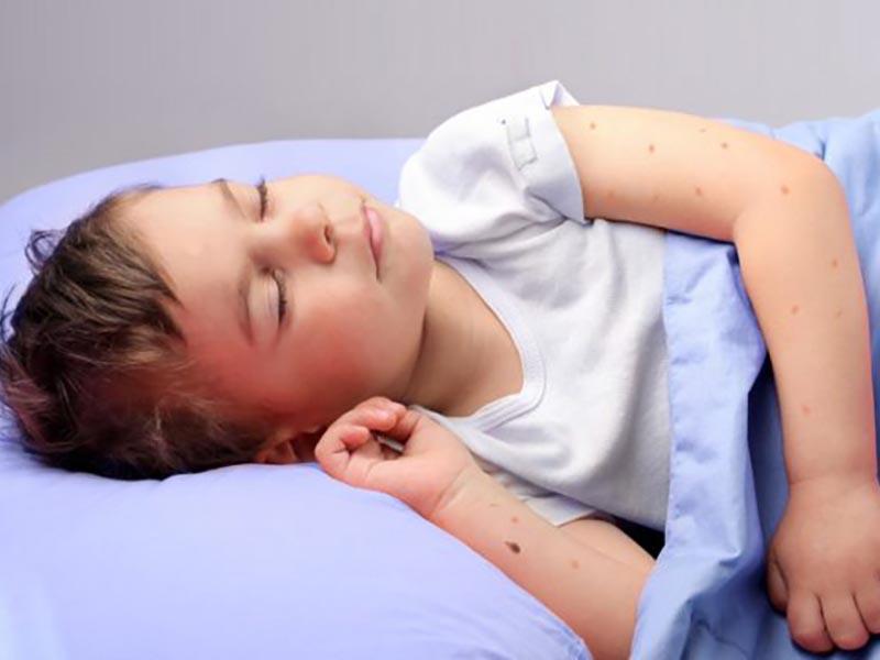 How bed bugs bite children - photo