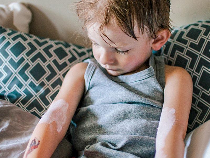 Treatment of bedbug bites in a child