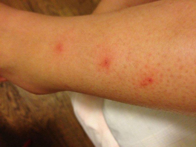 Furniture bugs - photos of bites