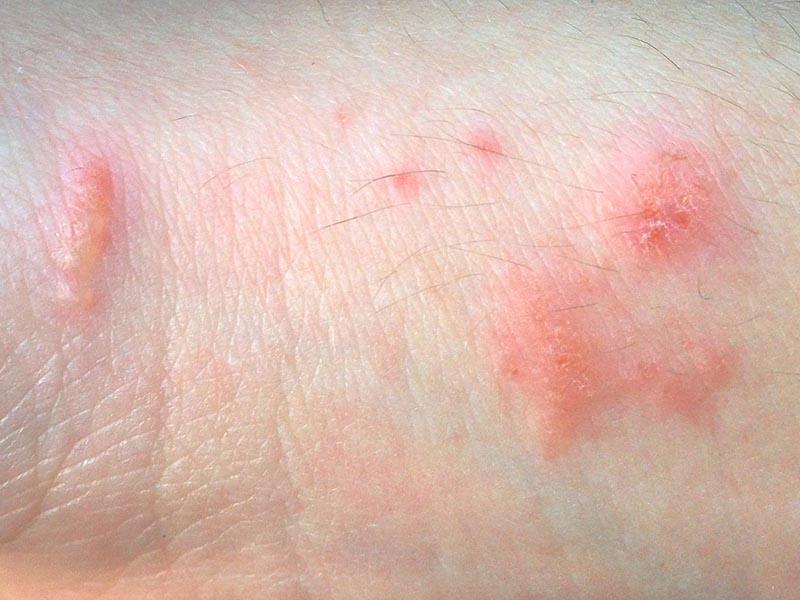 Anzeichen von Dermatitis