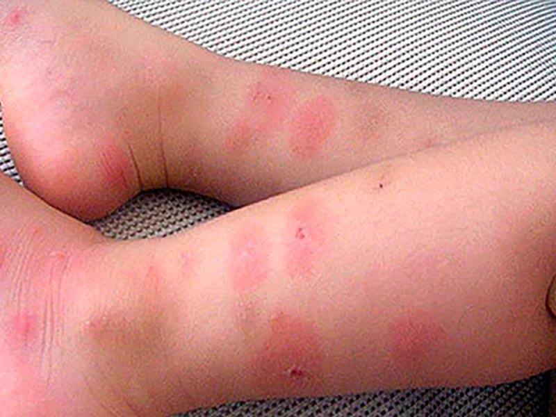 Ein Kind mit einer allergischen Reaktion auf Bisse