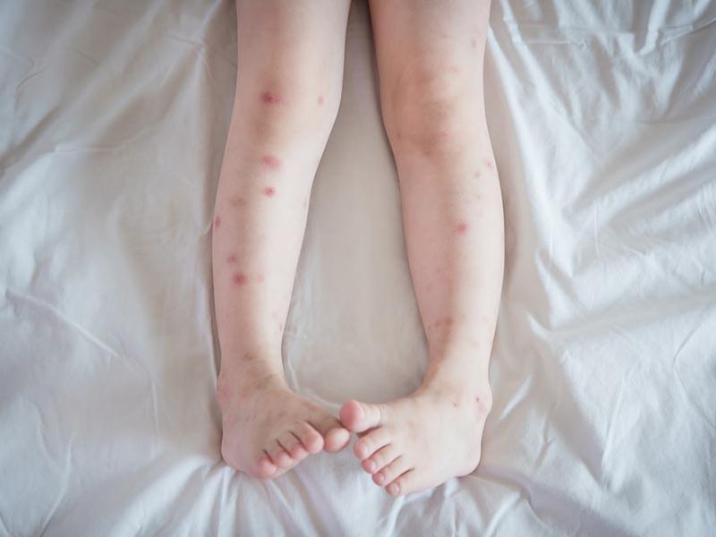 Bed bug bites at home on a child - photo