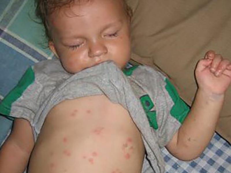 Bed bug bites on a child's body - photo