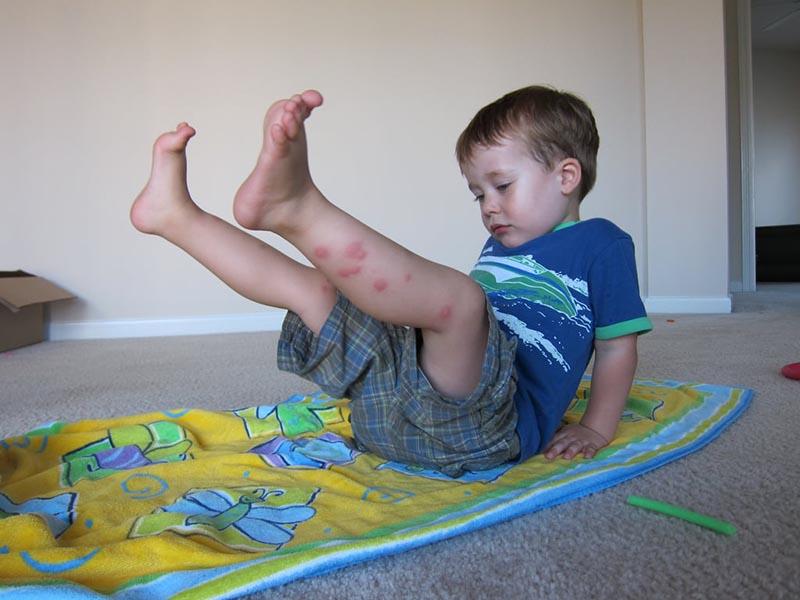 Bed bug bites in children - photo