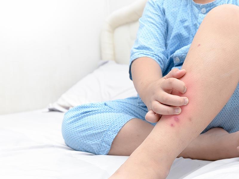 Bed bug bites in a child